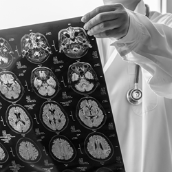 Traumatic brain injury claims - an international overview